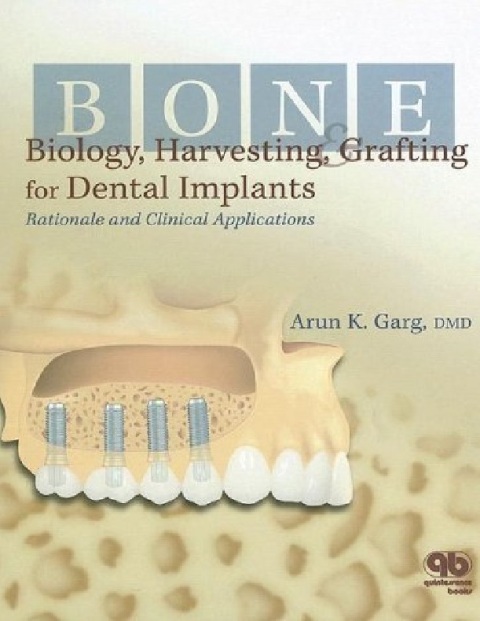 Bone Biology, Harvesting, & Grafting For Dental Implants Rationale and Clinical Applications by Arun K. Garg.