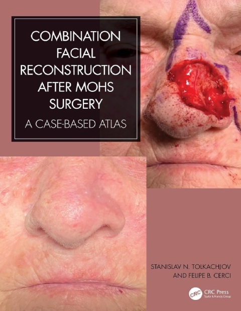 Combination Facial Reconstruction after Mohs Surgery A Case Based Atlas 1st Edition.